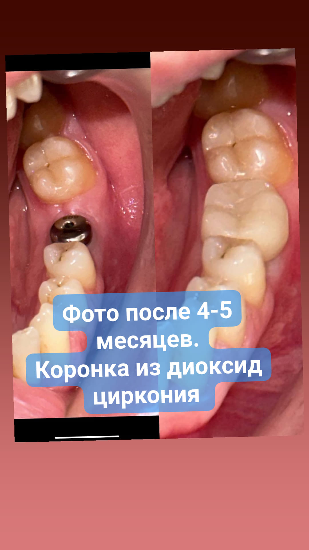 Имплантация зубов